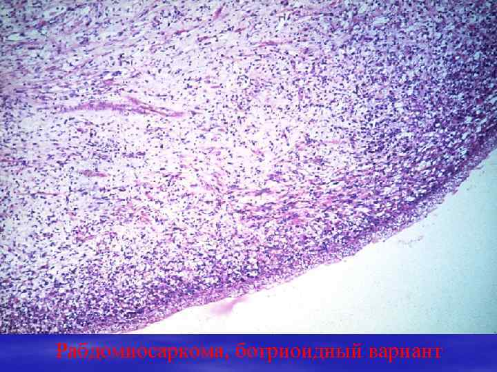 Рабдомиосаркома, ботриоидный вариант 