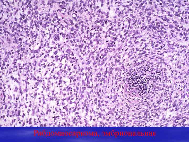 Эмбриональная рабдомиосаркома. Эмбриональная рабдомиосаркома гистология. Рабдомиосаркома мочевого пузыря. Альвеолярная рабдомиосаркома мягких тканей. Альвеолярная рабдомиосаркома гистология.