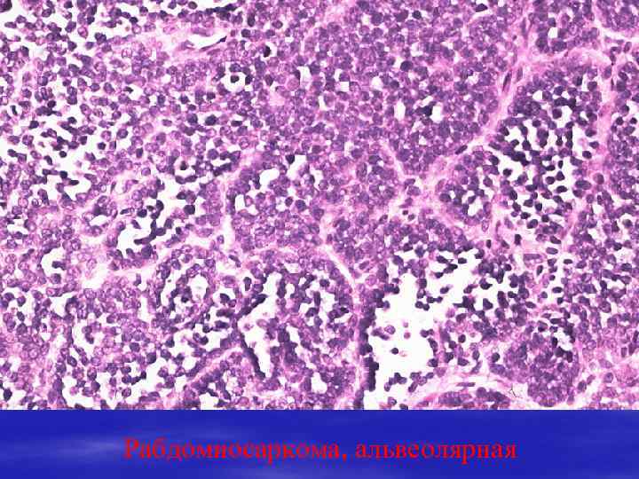 Рабдомиосаркома, альвеолярная 