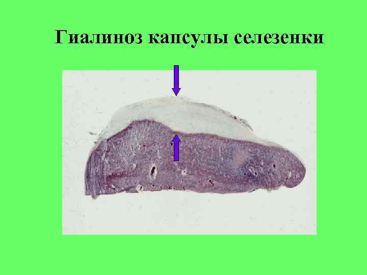 Гиалиноз плевры рисунок