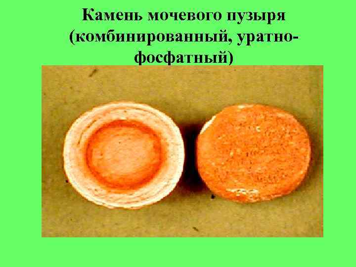 Камень мочевого пузыря (комбинированный, уратно- фосфатный) Камень мочевого пузыря (комбинированный, уратно- фосфатный)