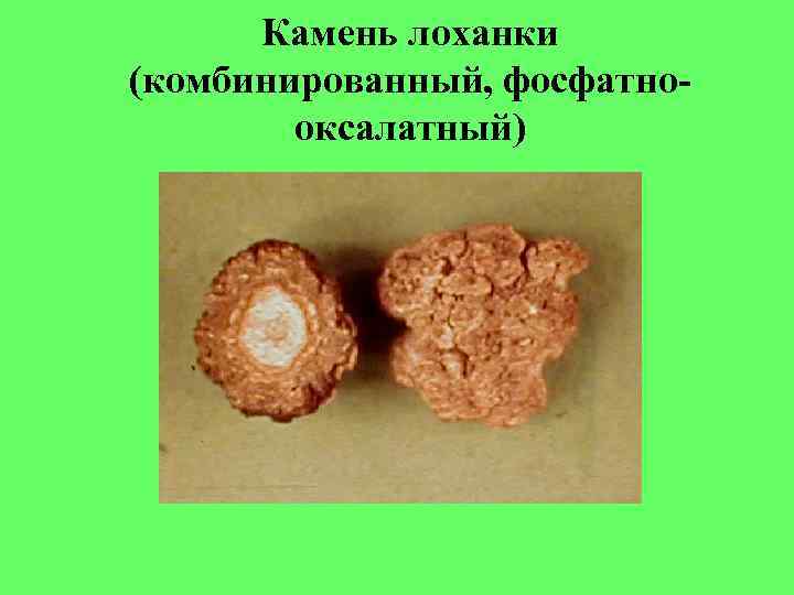 Камень лоханки (комбинированный, фосфатно- оксалатный) Камень лоханки (комбинированный, фосфатно- оксалатный)