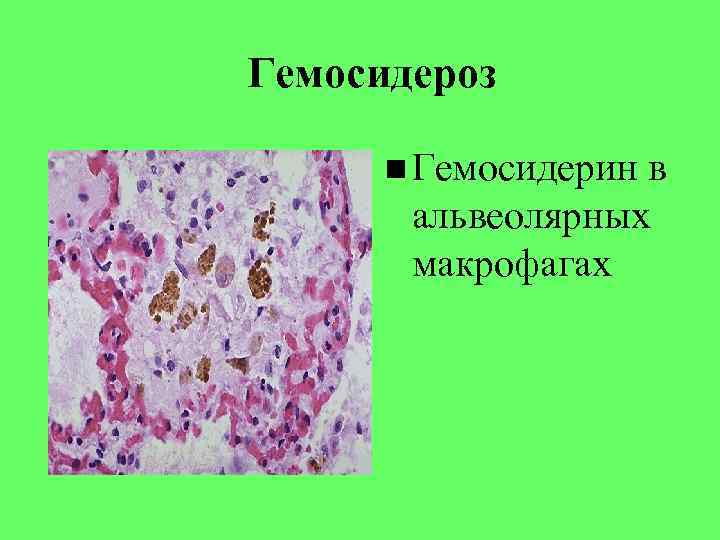 Патологическая анатомия лекции. Гемосидероз это патанатомия. Гемосидероз альвеолярных макрофагов.