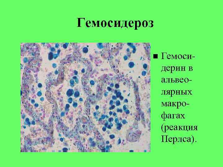 Гемосидероз Гемоси- дерин в альвео- Гемосидероз Гемоси- дерин в альвео-