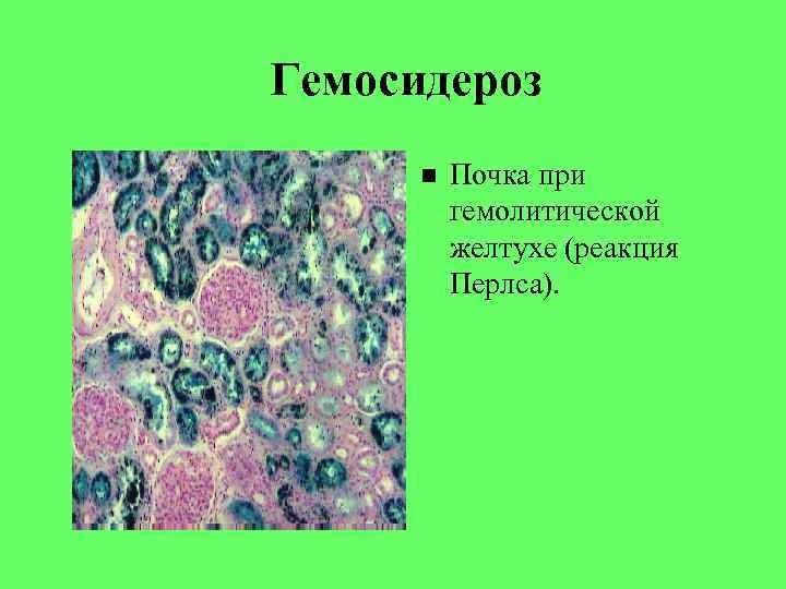 Роговая дистрофия. Гемосидероз печени патанатомия. Гемосидероз селезенки. Гемосидероз почки реакция Перлса.