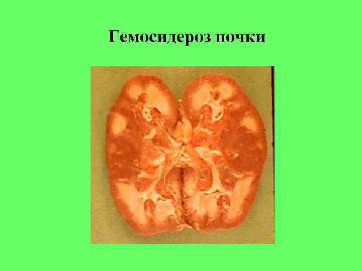 Гемосидероз почки Гемосидероз почки