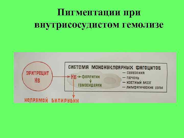 Пигментации при внутрисосудистом гемолизе Пигментации при внутрисосудистом гемолизе