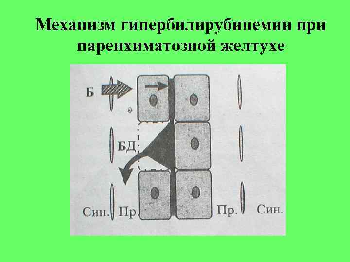 Механизм гипербилирубинемии при паренхиматозной желтухе Механизм гипербилирубинемии при паренхиматозной желтухе