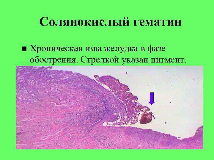 Хроническая язва желудка микропрепарат рисунок