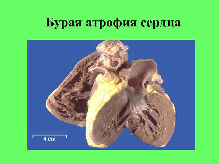 Бурая атрофия сердца Бурая атрофия сердца