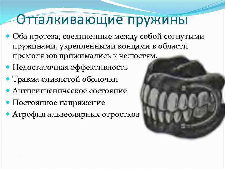  Отталкивающие пружины  Оба протеза, соединенные между собой согнутыми  пружинами, укрепленными концами