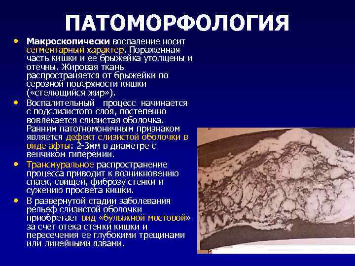   ПАТОМОРФОЛОГИЯ • Макроскопически воспаление носит сегментарный характер. Пораженная часть кишки и ее