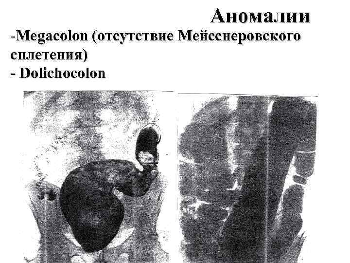      Аномалии -Megacolon (отсутствие Мейсснеровского сплетения) - Dolichocolon 