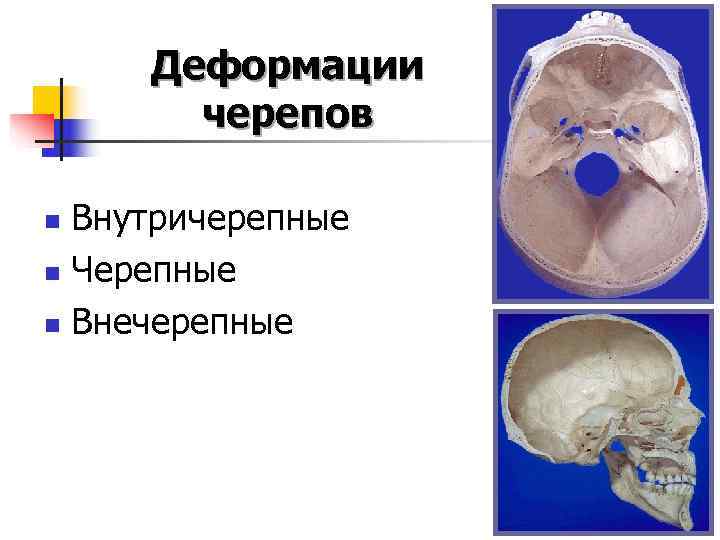  Деформации  черепов n Внутричерепные n Черепные n Внечерепные 