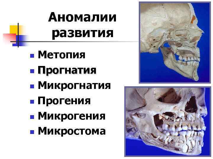  Аномалии развития n Метопия n Прогнатия n Микрогнатия n Прогения n Микростома