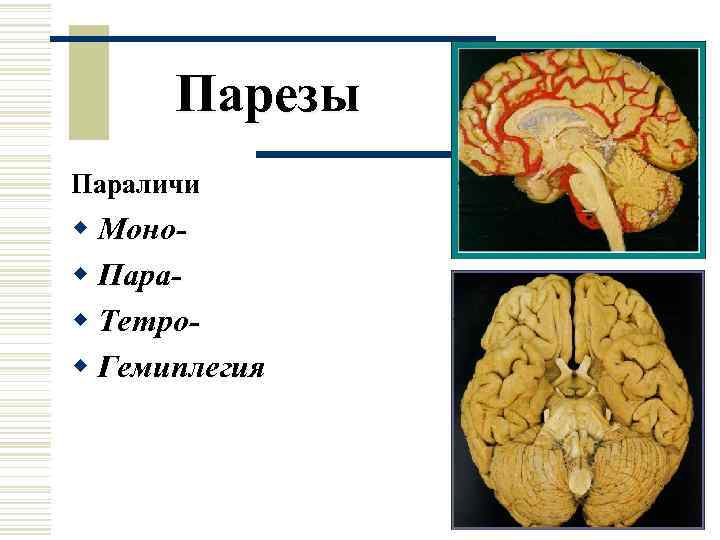  Парезы Параличи w Моно- w Пара- w Тетро- w Гемиплегия 