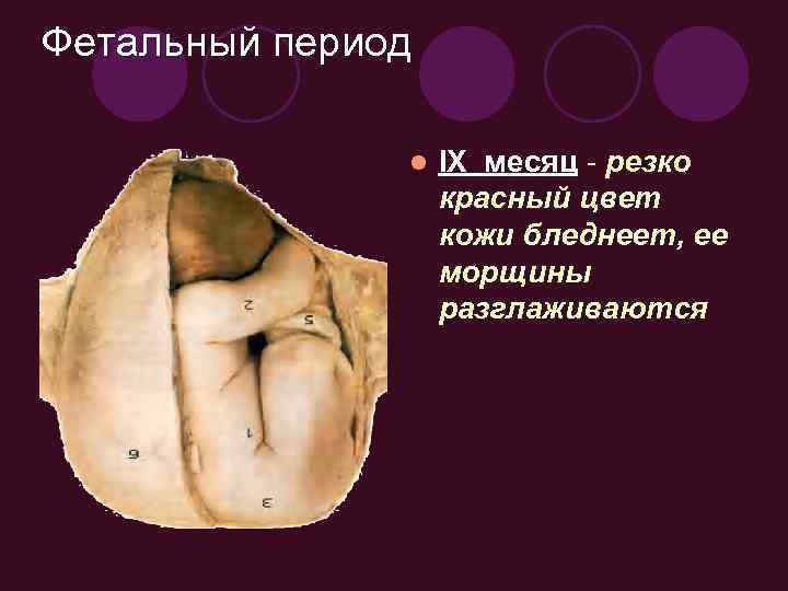 Фетальный период l IX месяц - резко красный цвет кожи бледнеет, ее морщины разглаживаются