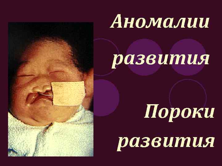 Аномалии развития Пороки развития 