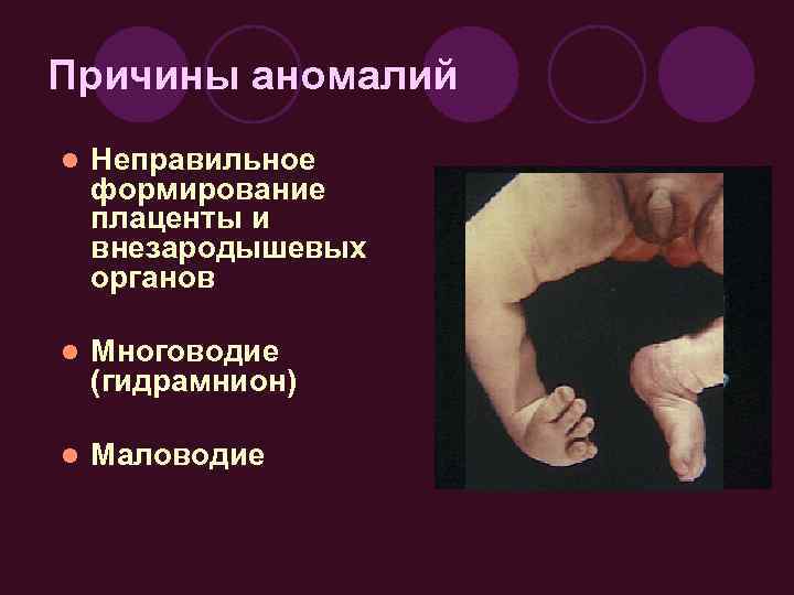 Причины аномалий l Неправильное формирование плаценты и внезародышевых органов l Многоводие (гидрамнион) l Маловодие