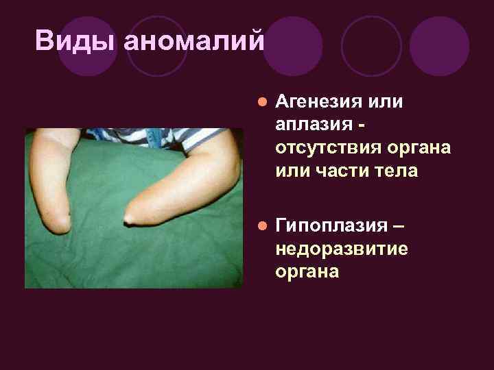 Виды аномалий l Агенезия или аплазия отсутствия органа или части тела l Гипоплазия –