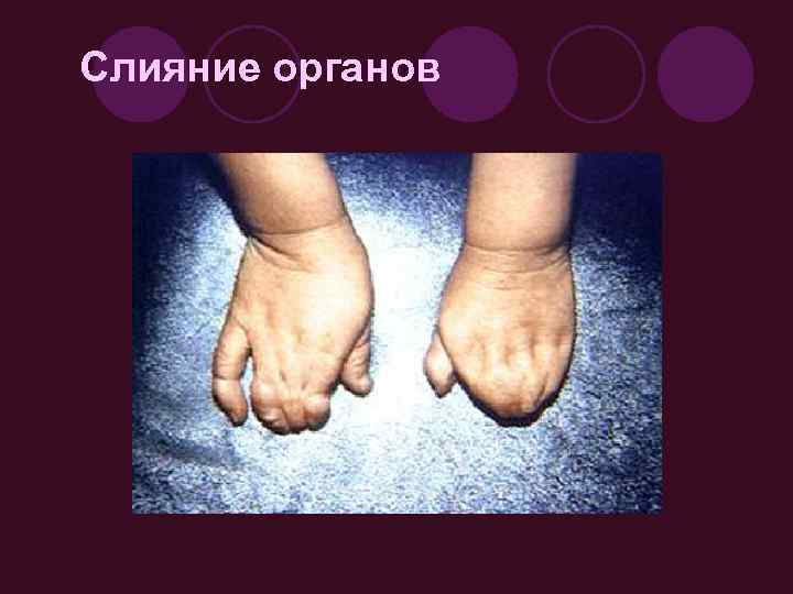 Слияние органов 