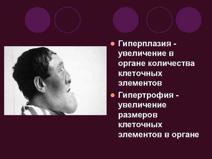 Гиперплазия увеличение в органе количества клеточных элементов l Гипертрофия увеличение размеров клеточных элементов в