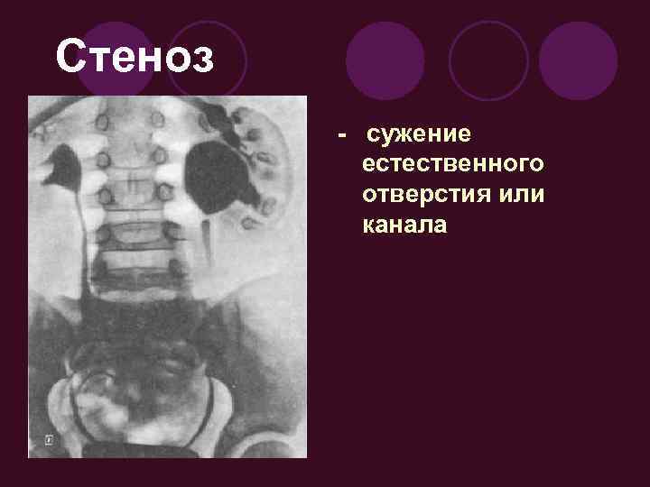 Стеноз - сужение естественного отверстия или канала 