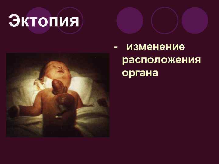 Эктопия - изменение расположения органа 