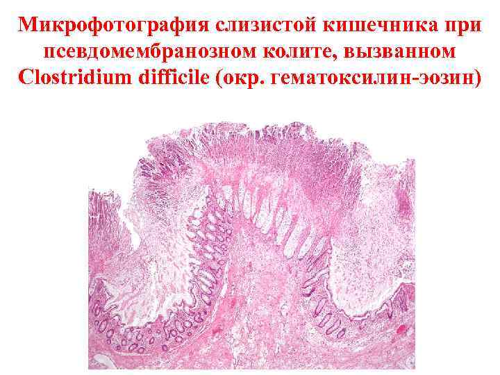 Микрофотография слизистой кишечника при  псевдомембранозном колите, вызванном Clostridium difficile (окр. гематоксилин-эозин) 