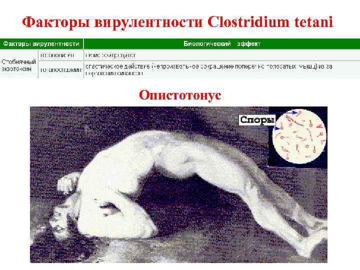 Факторы вирулентности Clostridium tetani    Опистотонус 