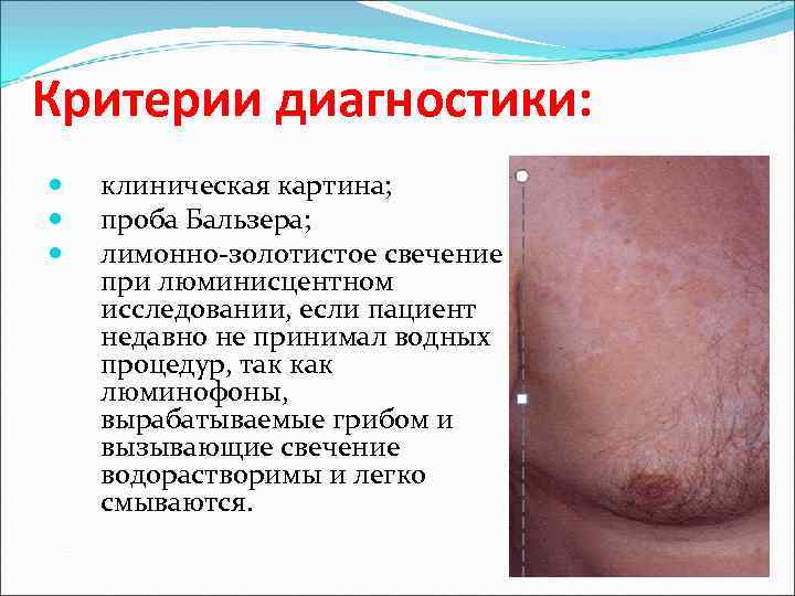 Критерии диагностики: клиническая картина; проба Бальзера; лимонно-золотистое свечение при люминисцентном исследовании, если пациент недавно