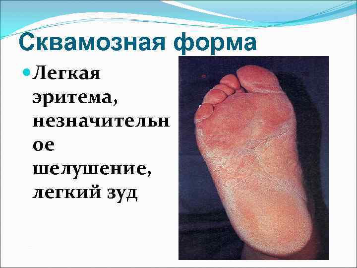 Сквамозная форма Легкая эритема,  незначительн ое шелушение,  легкий зуд 