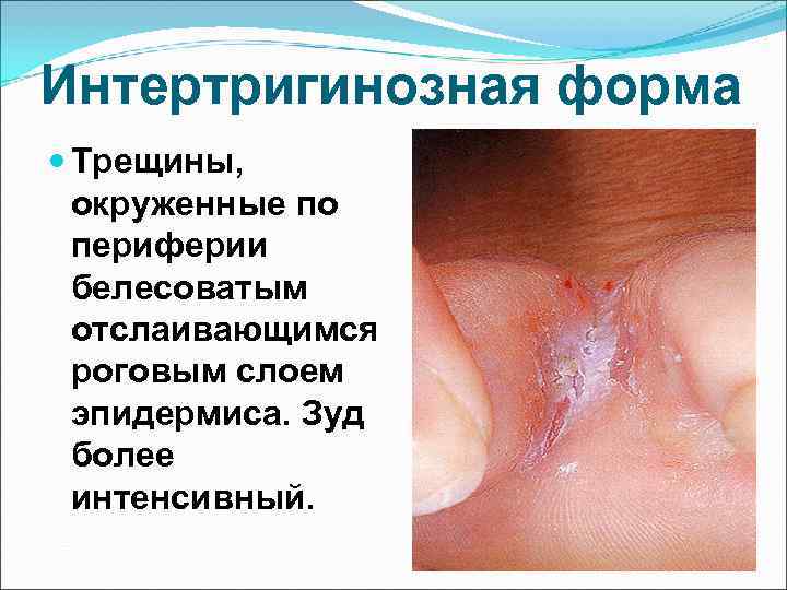 Интертригинозная форма  Трещины,  окруженные по  периферии  белесоватым  отслаивающимся 