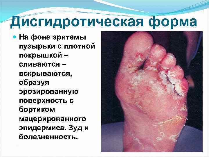 Дисгидротическая форма  На фоне эритемы  пузырьки с плотной  покрышкой – 