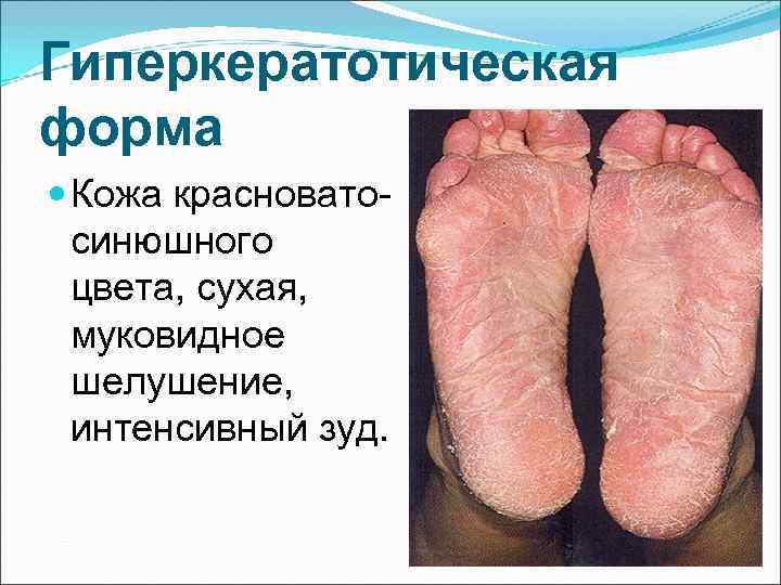 Гиперкератотическая форма  Кожа красновато-  синюшного  цвета, сухая,  муковидное  шелушение,