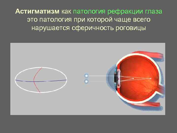 Астигматизм как патология рефракции глаза  это патология при которой чаще всего нарушается сферичность