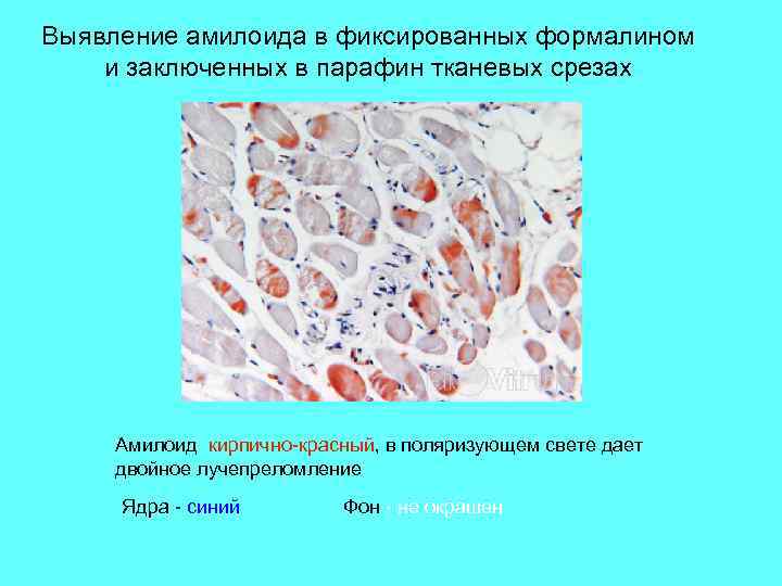 Выявление амилоида в фиксированных формалином и заключенных в парафин тканевых срезах  Амилоид кирпично-красный,