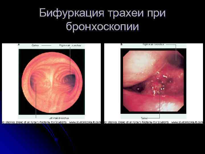 Бифуркация трахеи при бронхоскопии 