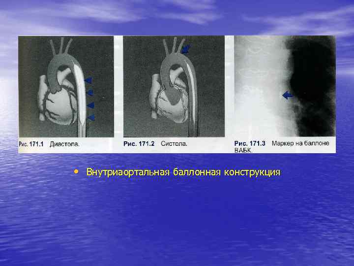  • Внутриаортальная баллонная конструкция 