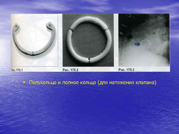  • Полукольцо и полное кольцо (для натяжения клапана) 