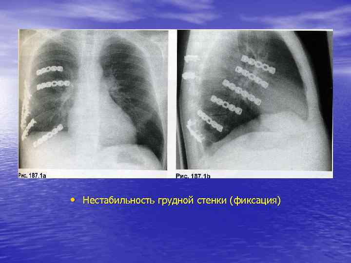  • Нестабильность грудной стенки (фиксация) 