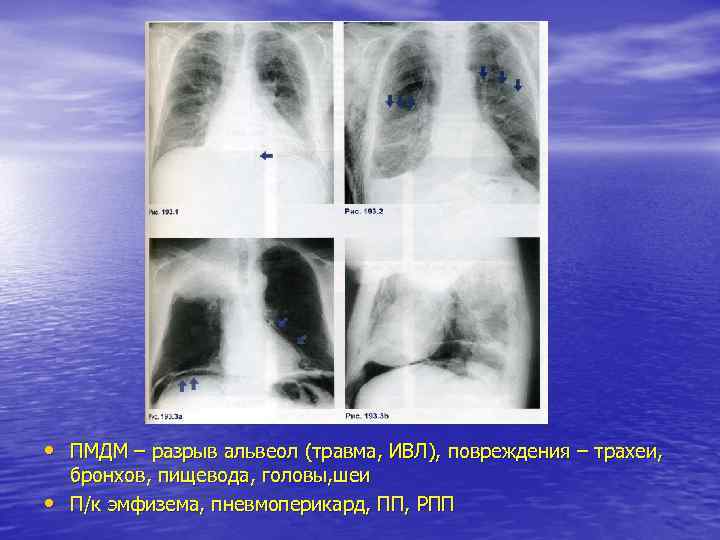  • ПМДМ – разрыв альвеол (травма, ИВЛ), повреждения – трахеи, бронхов, пищевода, головы,