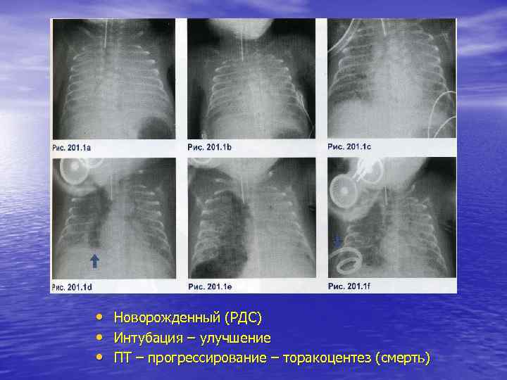  •  Новорожденный (РДС) •  Интубация – улучшение •  ПТ –