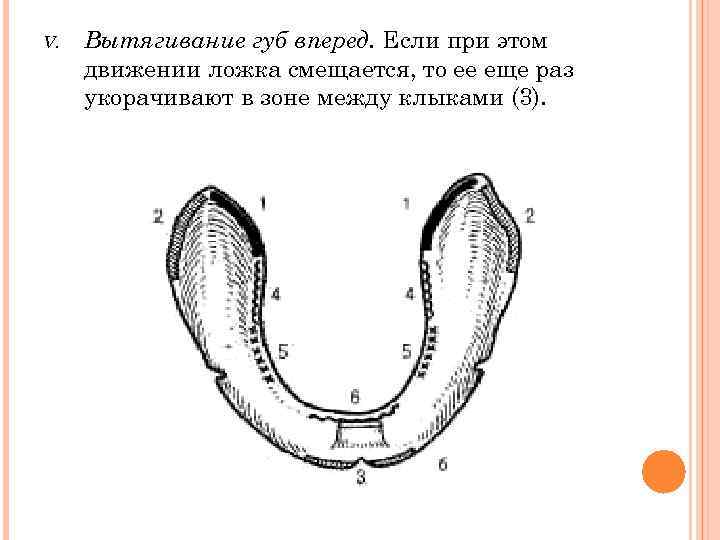 V.  Вытягивание губ вперед. Если при этом движении ложка смещается, то ее еще