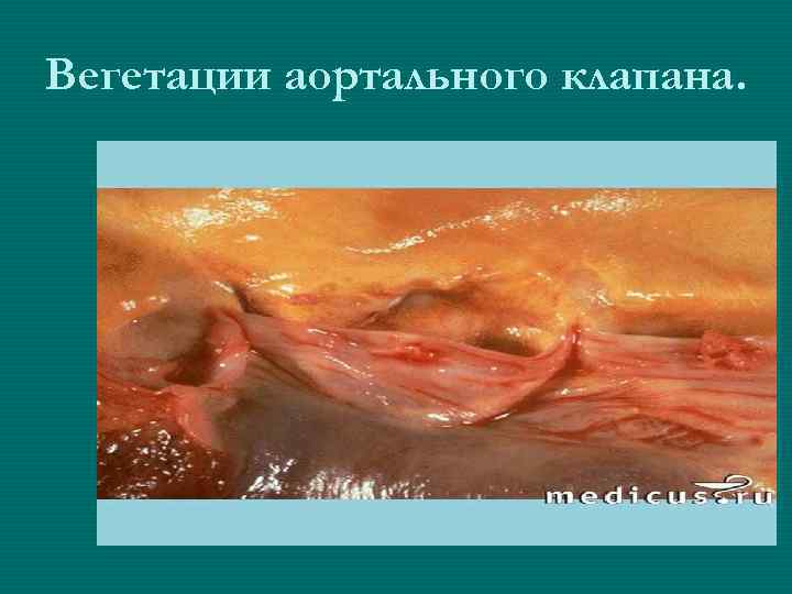 Вегетации аортального клапана. 