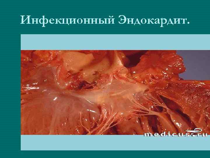 Инфекционный Эндокардит. 