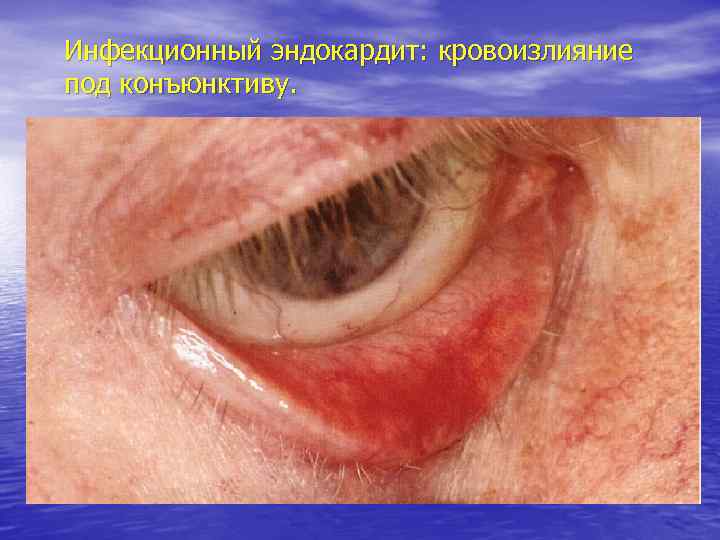 Инфекционный эндокардит: кровоизлияние под конъюнктиву. 