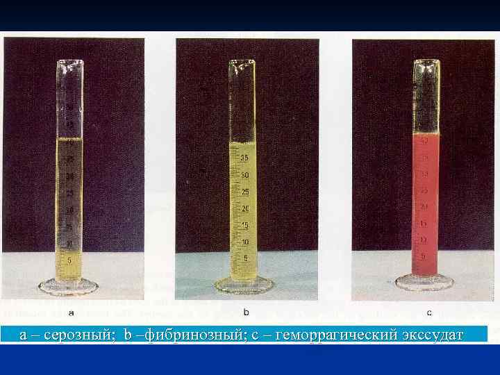 а – серозный; b –фибринозный; с – геморрагический экссудат 
