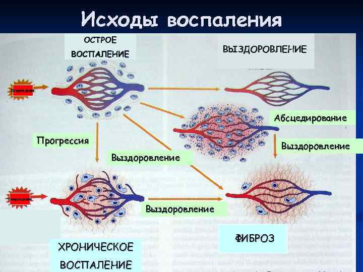     Исходы воспаления    ОСТРОЕ    