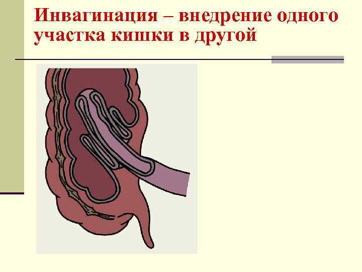 Инвагинация – внедрение одного участка кишки в другой 
